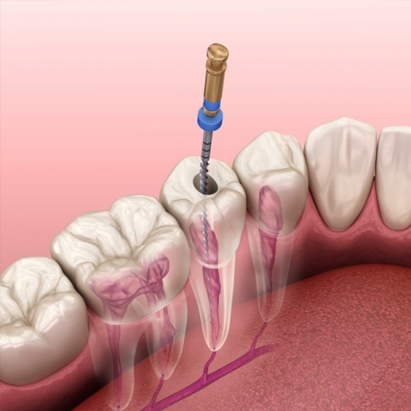 Endodonti (Kanal Tedavileri)